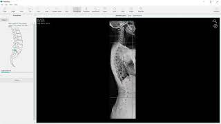 Sagittal Balance:how to calculate the angle before surgery