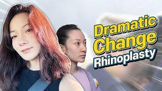 From Disappointment to Delight #RevisionRhinoplasty at NANA plastic surgery in Korea