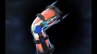 A Breakthrough in Knee Arthritis and Injury Management - Spring Loaded Bionic Knee Braces