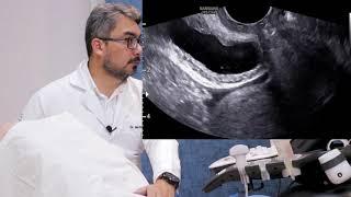 Aula 32: Curso de ultrassonografia para pesquisa de endometriose,  passo 3 sinal do deslizamento.