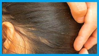 How to Eliminate Lice and Nits in a Single Day 3 Home Remedies