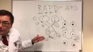 RAPD, Relative Afferent Pupillary Defect, Marcus-Gunn pupil