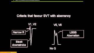 12-15 Lead ECG:  VT vs. SVT