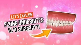 How To Fix An UNDERBITE Without Surgery!