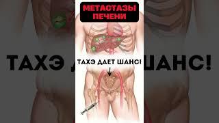 Как очистить ПЕЧЕНЬ от МЕТАСТАЗОВ и ОПУХОЛЕЙ методом ТАХЭ? #меднавигатор #рак #печень #метастазы