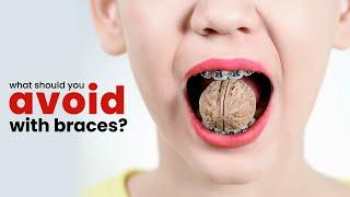 What Can You Eat with Braces, and What Should You Avoid?