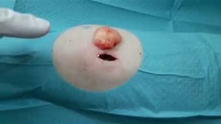 Surgical removal of lipoma with lipomatosis on the arm