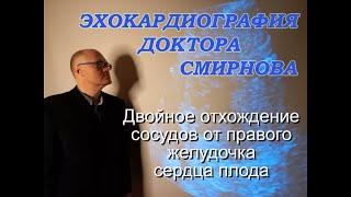 7. Двойное отхождение сосудов от правого желудочка у плода