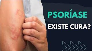 EXISTE CURA PARA PSORÍASE? [ DESCUBRA! ]