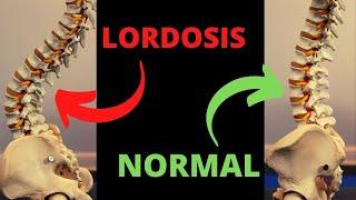 Lordosis Correction Exercises  - 2 Stretches + 6 Exercises.