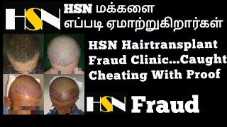 HSN HairTransplant Disadvantages Cons HSNHairTransplant 100 days result HSN Fraud All proof Included