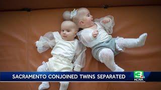 Celebrating a miracle: Conjoined twin girls successfully separated at UC Davis Medical Center