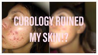 CUROLOGY MADE MY ACNE WORSE?! I Honest 5 Month Review