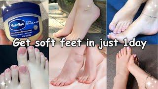 HOW I Got SOFT FEET in just 1 day  naturally