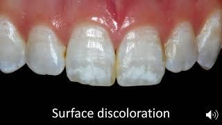 Case Selection for Enamel Microabrasion