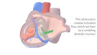 Mitral Stenosis - sound & animation