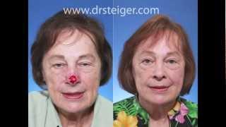 Nasal Reconstruction with a Forehead Flap in South Florida