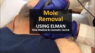 Remove Mole from Back of Neck using Ellman Machine  - Nitai Medical & Cosmetic Centre