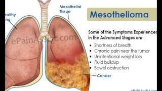 Mesothelioma Survival Rates