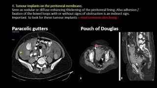 Imaging in Peritoneal Carcinomatosis