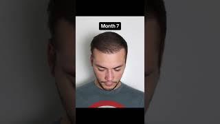 #hairtransplant journey 12 months results #bogotahairlines #transplantecapilar #hairlosstreatment