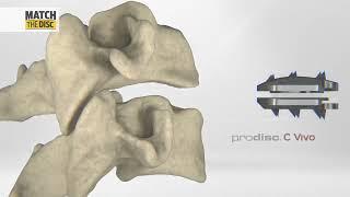 Centinel Spine: prodisc C Portfolio l Award winning Disc Replacement Technology