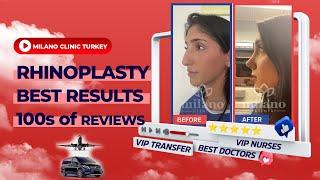 Rhinoplasty in Turkey (Cost, Reviews, Results, Before, After) – Milano Clinic