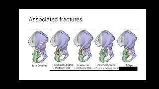 Acetabulum fracture classification