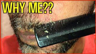 Beard and eyebrow Flakes | DANDRUFF FLAKES | SEBORRHEIC DERMATITIS | PitaFlakes