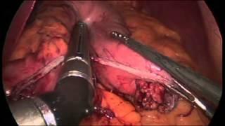 Sleeve Gastrectomy Demonstration: Memorial Weight-Loss Surgery Program