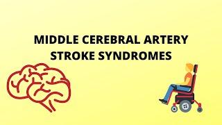 Middle Cerebral Artery Stroke Syndromes | Anatomy | Clinical features |