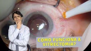 Como funciona a Vitrectomia? | Dr. João Paulo Lomelino