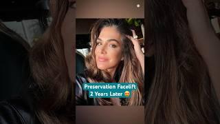 Beauty Queen’s Preservation Facelift 2 Years Later