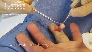 Awake Hand Surgery