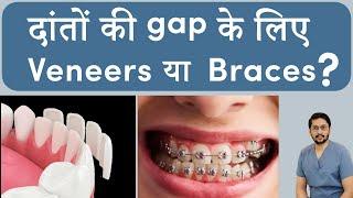 India's Most Popular Teeth Gap Treatment Options (2024) | Dental veneers in India| Braces in Indore