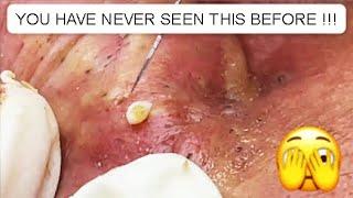 UNBELIEVABLE !!! THIS MAN HAS A FACE AND EARS FULL OF BLACKHEADS  YOU HAVE NEVER SEEN THIS BEFORE