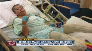 Loveland teen makes painful choice to have legs amputated