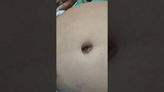 Umbilical hernia  हर्निया कैसा दिखता है @DrAshishSachan