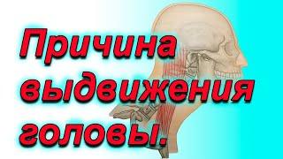 Выдвижение головы вперед. Причины.