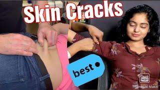 Best Skin Cracking All the Time Compilation | Skin Cracking ASMR | Loud & Best Skin Cracking