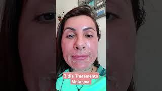 TERCERO DIA tratamento MELASMA #melasma #tratamentomelasma