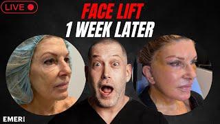 1 WEEK POST OP AFTER FULL FACIAL LIFTING SURGERY AND LASER COMBINATION | Dr. Jason Emer