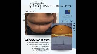 ABDOMINOPLASTY before and after - Houston Plastic Surgeon Dr. Franklin Rose