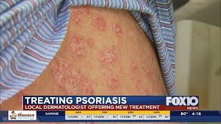 New treatment for psoriasis