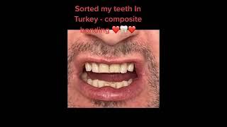 Uzmanlar Dental Clinic – Composite Bonding