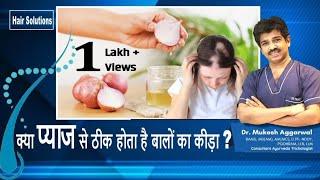 ऐसे ठीक करें बालों में लगे कीड़े को | Treatment of Patchy Hair Loss | Hair Solutions - Episode 3