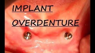 Implant Overdenture Planning - Part 1| Implant Supported Overdenture - Step by Step Planning.