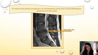 Intervertebral foramen and the vertebral foramina