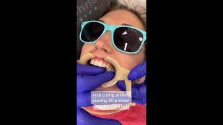 How LightForce #braces are put on. #LightForce #BracesColors #bracestreatment