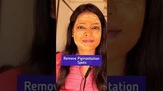 Remove Extreamy Dark Pigmentation Spots | Home Remedy For Pigmentation #shorts | Shinny Roops